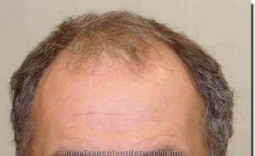 Hair restoration procedure results