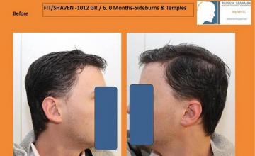 Hair restoration procedure before images