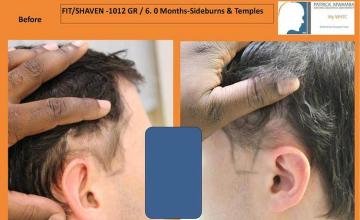 Hair transplantation surgery before images