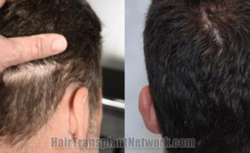 Back view before and after hair transplantation 