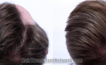 Back view before and after hair transplantation 