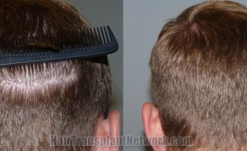 Back view before and after hair transplantation 