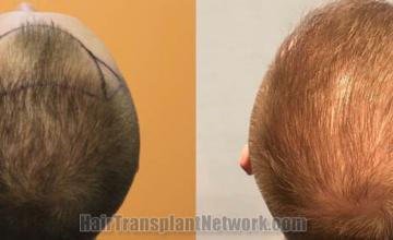 Top view - Before and after surgical hair replacement