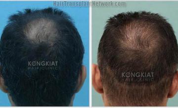 Hair transplantation procedure before and after photographs