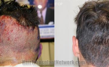 Back view before and after hair transplantation 