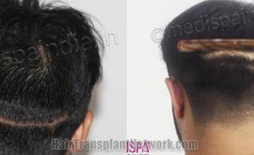 Back view before and after hair transplantation 