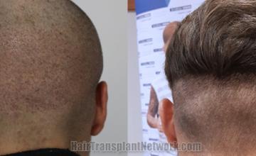 Back view before and after hair transplantation 