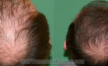 Back view before and after hair transplantation 