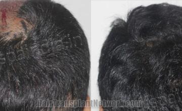 Back view before and after hair transplantation 