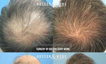 Surgical hair transplantation result photographs