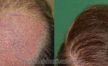 Back view before and after hair transplantation photos