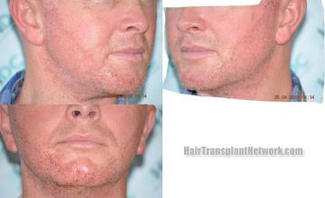 Hair restoration procedure before and after pictures