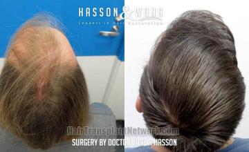 Surgical hair transplantation result photographs