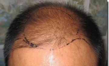 Hair restoration procedure results