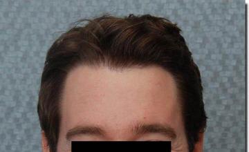 Hair restoration procedure results