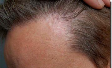 Hair restoration procedure results