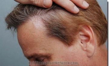 Hair restoration procedure results