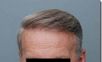 Hair restoration procedure results