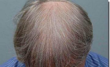 Hair restoration procedure results