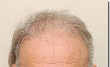 Hair restoration procedure results