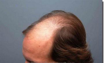 Hair restoration procedure results