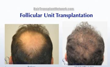 Hair restoration procedure before and after results