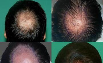 Hair restoration procedure before and after pictures