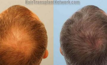 Before and after hair transplantation result photographs