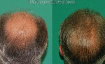 Hair transplantation procedure before and after photographs