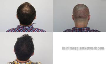 Surgical hair transplantation result photographs