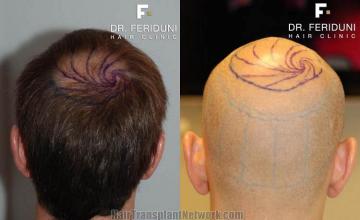 Hair transplantation surgery before and after photos