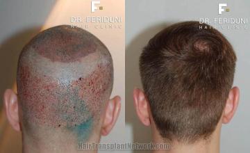 Hair transplantation surgery before and after images