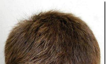 Hair restoration procedure results