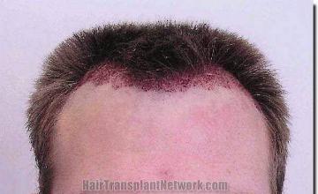 Hair restoration procedure results