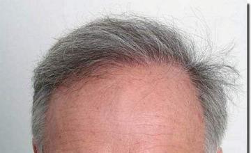 Hair restoration procedure results