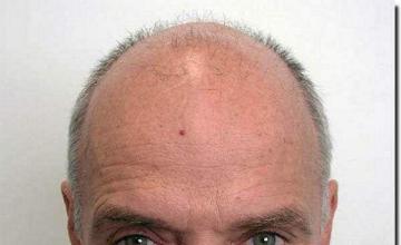 Hair restoration procedure results