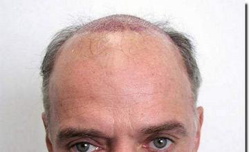 Hair restoration procedure results