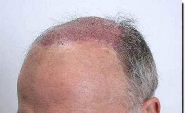 Hair restoration procedure results