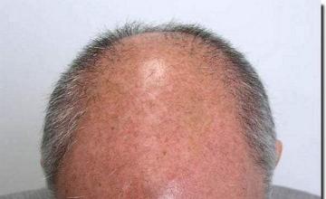 Hair restoration procedure results