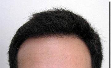 Hair restoration procedure results