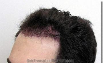 Hair restoration procedure results