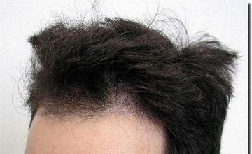 Hair restoration procedure results