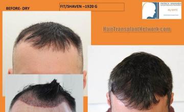 Hair restoration procedure before and after results