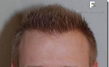 Hair restoration procedure results