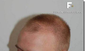 Hair restoration procedure results