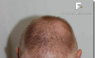 Hair restoration procedure results