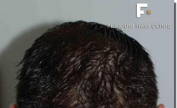 Hair restoration procedure results