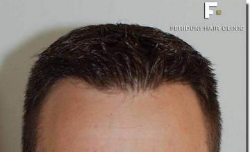 Hair restoration procedure results