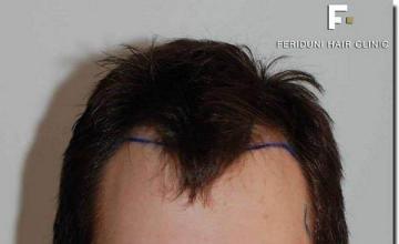 Hair restoration procedure results