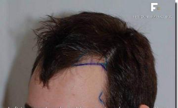 Hair restoration procedure results